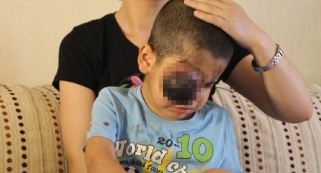 Kanlı Gözyaşı Döken Minik Emir, İlacını Bekliyor