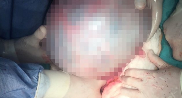 (özel Haber) Karpuz Büyüklüğündeki 5 Kiloluk Kist Şaşırttı