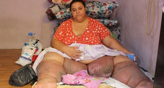 Tek Göz Odada 220 Kiloyla Yaşam Savaşı